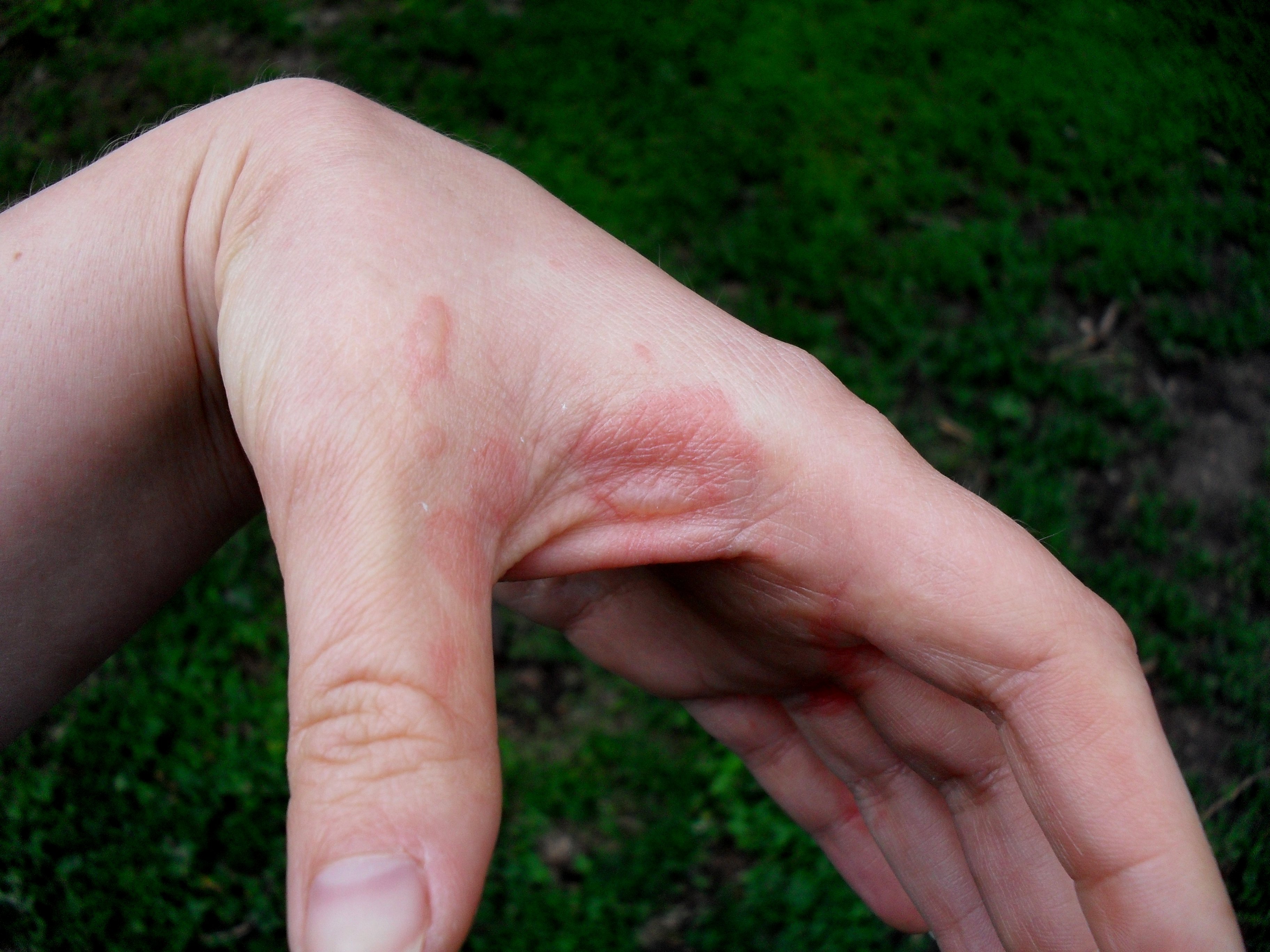 Sign you might Burn your hands. Burned hand